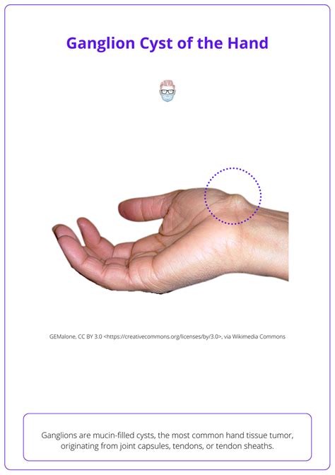 icd 10 code for right wrist ganglion cyst|Ganglion Cyst ICD